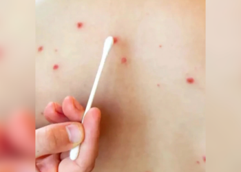 Alertan por 60 casos de sarampión en Chihuahua