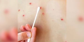 Alertan por 60 casos de sarampión en Chihuahua