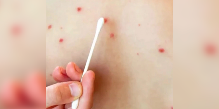 Alertan por 60 casos de sarampión en Chihuahua