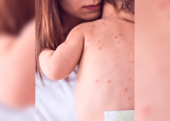 Aumentan casos de sarampión en Chihuahua