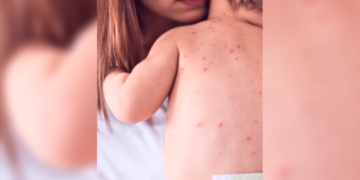 Aumentan casos de sarampión en Chihuahua