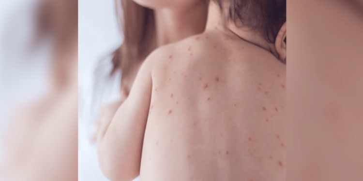 Cuauhtémoc concentra la mayoría de casos de sarampión en Chihuahua