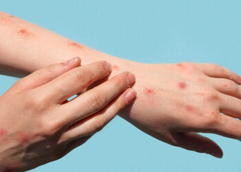 Catorce muertes por sarampión en Chihuahua