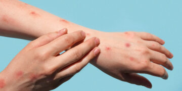 Catorce muertes por sarampión en Chihuahua