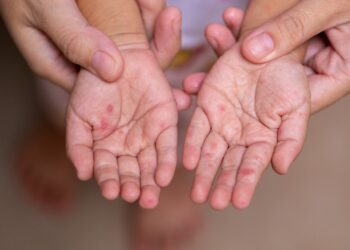 Brotes de virus Coxsackie afectan a más de 400 personas en Chihuahua