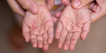 Brotes de virus Coxsackie afectan a más de 400 personas en Chihuahua