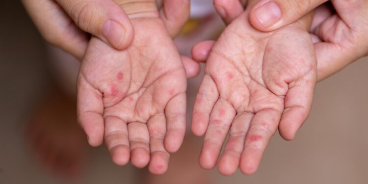 Brotes de virus Coxsackie afectan a más de 400 personas en Chihuahua