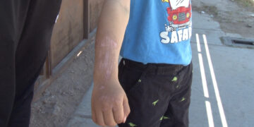 Dan de alta a niño atropellado en parque de Vistas del Norte